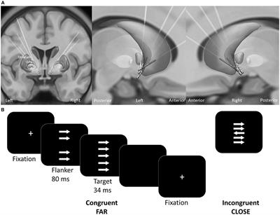 Error-Related Activity in Striatal Local Field Potentials and Medial Frontal Cortex: Evidence From Patients With Severe Opioid Abuse Disorder